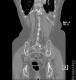 CT colon 42